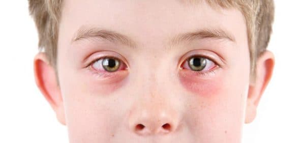 аллергия вокруг глаз